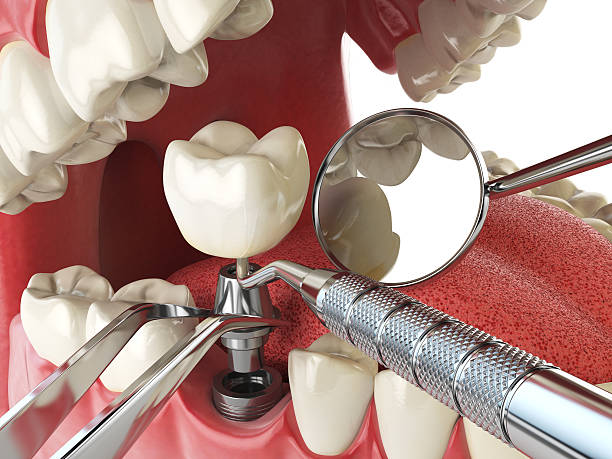 Best Emergency Treatment for Dental Infections or Abscesses in Baraboo, WI