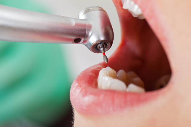 Best Emergency Dental Care for Broken or Chipped Teeth in Baraboo, WI